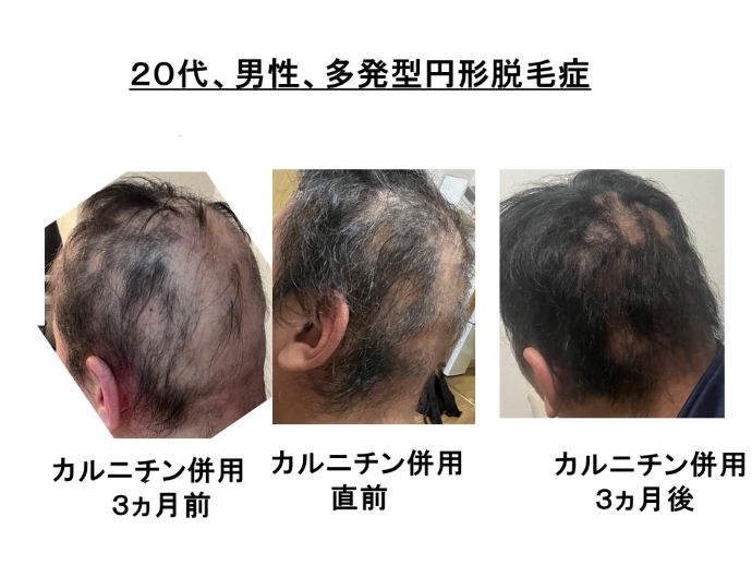 円形脱毛症　病院